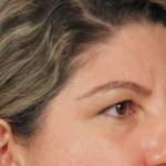 Brow Lift Before & After Patient #3419