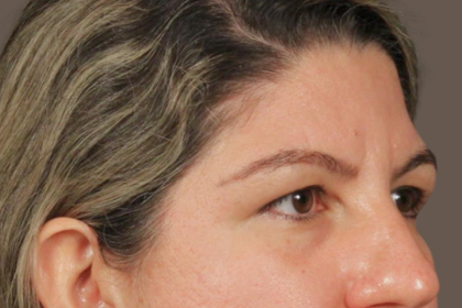 Brow Lift Before & After Patient #3419