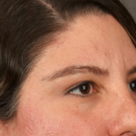 Brow Lift Before & After Patient #3419
