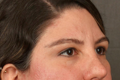 Brow Lift Before & After Patient #3419