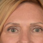 Brow Lift Before & After Patient #3454
