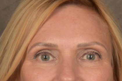 Brow Lift Before & After Patient #3454