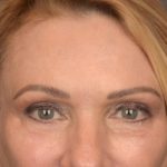 Brow Lift Before & After Patient #3454