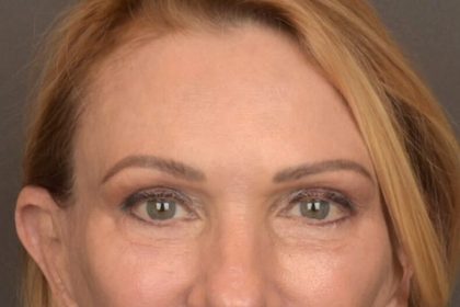 Brow Lift Before & After Patient #3454