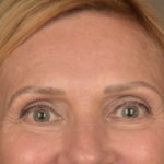 Brow Lift Before & After Patient #3454