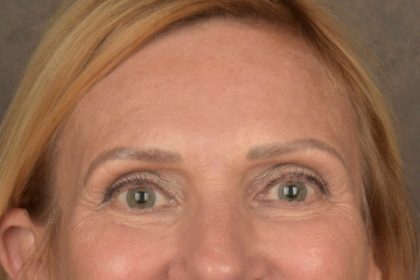 Brow Lift Before & After Patient #3454