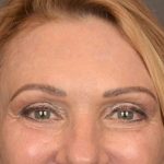Brow Lift Before & After Patient #3454