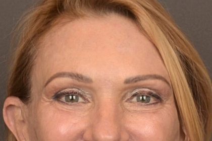 Brow Lift Before & After Patient #3454