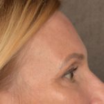 Brow Lift Before & After Patient #3454