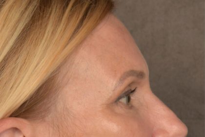 Brow Lift Before & After Patient #3454