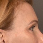 Brow Lift Before & After Patient #3454