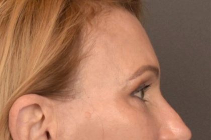 Brow Lift Before & After Patient #3454