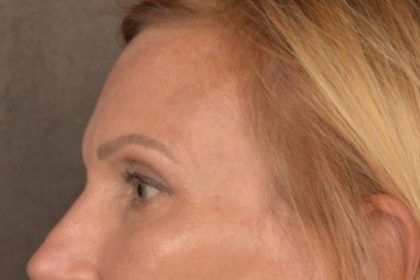 Brow Lift Before & After Patient #3454