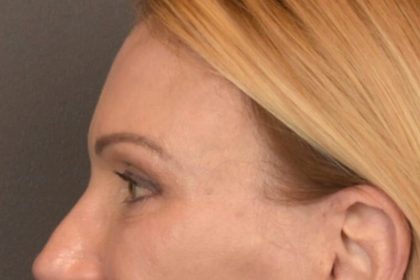 Brow Lift Before & After Patient #3454