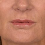 Lip Lift Before & After Patient #3455