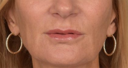 Lip Lift Before & After Patient #3455
