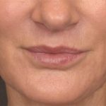 Lip Lift Before & After Patient #3455