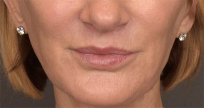 Lip Lift Before & After Patient #3455