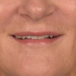 Lip Lift Before & After Patient #3455
