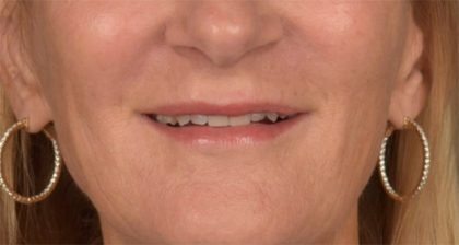 Lip Lift Before & After Patient #3455