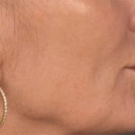 Lip Lift Before & After Patient #3455