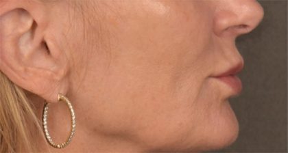 Lip Lift Before & After Patient #3455