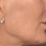 Lip Lift Before & After Patient #3455