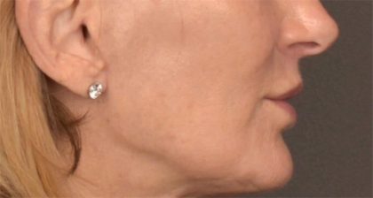Lip Lift Before & After Patient #3455