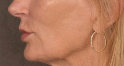 Lip Lift Before & After Patient #3455