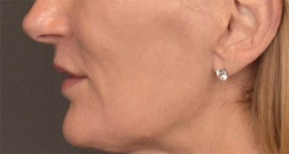Lip Lift Before & After Patient #3455