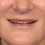 Lip Lift Before & After Patient #3455