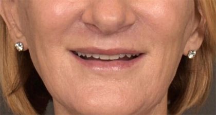 Lip Lift Before & After Patient #3455