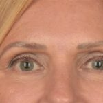 Blepharoplasty Before & After Patient #3457