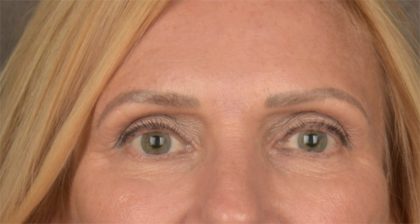 Blepharoplasty Before & After Patient #3457