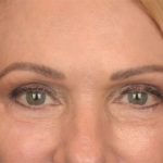 Blepharoplasty Before & After Patient #3457