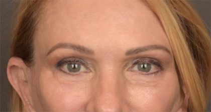 Blepharoplasty Before & After Patient #3457