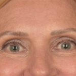 Blepharoplasty Before & After Patient #3457