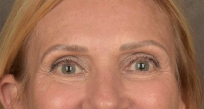 Blepharoplasty Before & After Patient #3457