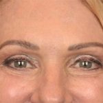 Blepharoplasty Before & After Patient #3457