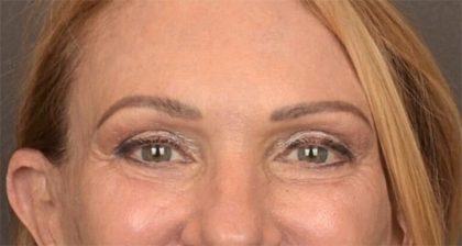 Blepharoplasty Before & After Patient #3457