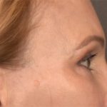 Blepharoplasty Before & After Patient #3457