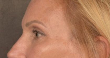 Blepharoplasty Before & After Patient #3457
