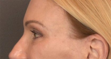 Blepharoplasty Before & After Patient #3457