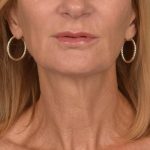 Neck Lift Before & After Patient #3459