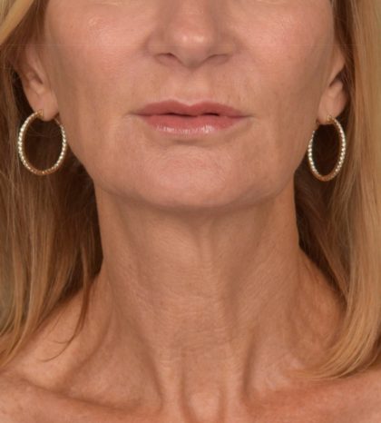 Neck Lift Before & After Patient #3459