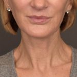 Neck Lift Before & After Patient #3459