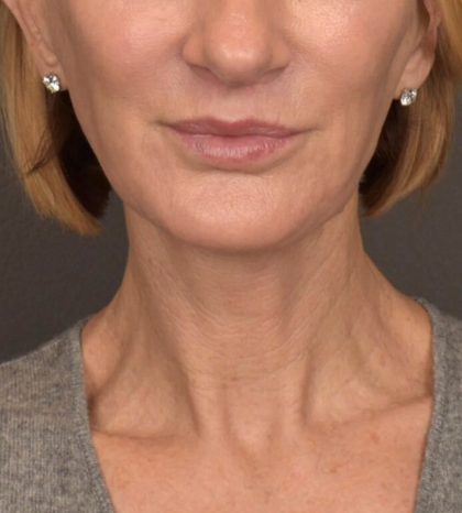 Neck Lift Before & After Patient #3459