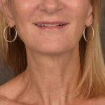 Neck Lift Before & After Patient #3459