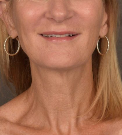 Neck Lift Before & After Patient #3459
