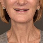 Neck Lift Before & After Patient #3459